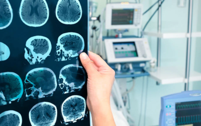 La enfermedad de Alzheimer puede dañar el cerebro en solo dos fases